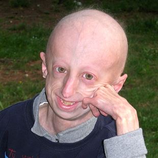 Allo Spira Mirabilis Sammy Basso parla della Progeria e dell'amore per la vita